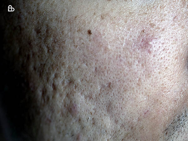 Board-certified dermatologist performing CO₂ laser resurfacing for deep scars and wrinkles